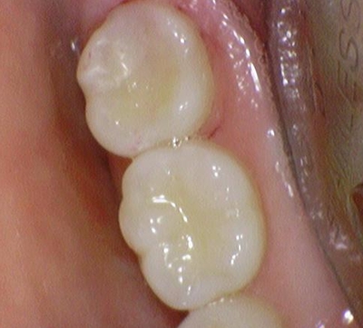 광화문/시청역"까만 아말감, 금니가 보기 싫다면?" 관련 이미지 2