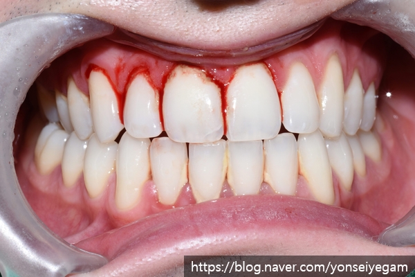[서울시청역치과/잇몸치료]Q.잇몸에서 피가 나요 관련 이미지 5