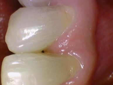 해외에서도 찾아오는 앞니레진치료, 광화문 시청역 서울역 근처 연세예감치과 외국인도 찾는 이유 관련 이미지 7