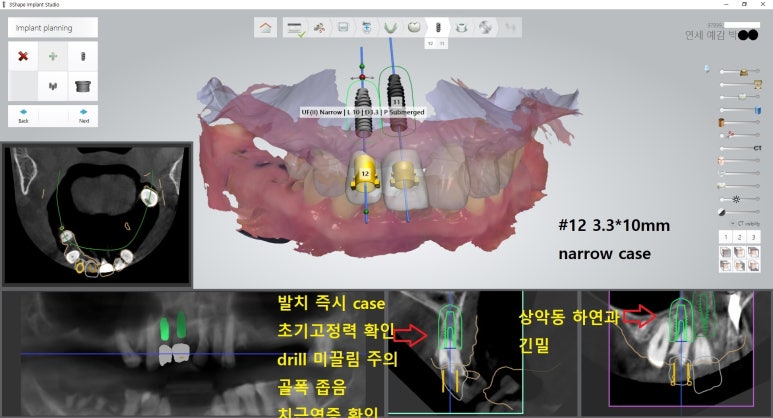 시청역 광화문  최소절개 또는 비절개로 가능한 네비게이션 임플란트 유명한 치과 내비게이션소개드려요 관련 이미지 7
