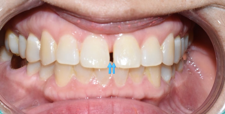 치아 앞니 벌어짐 벌어진 앞니&rarr;레진치료 비용까지 알려드려요 관련 이미지 4