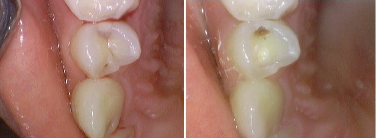 순화동 가까운 충치치료 치과 해외에서도 찾아오는 연세 예감 치과 관련 이미지 4