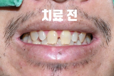 외국인환자의 왜소치 및 치아사이 공간으로 인한 서울 무삭제 라미네이트 & 최소삭제라미네이트 6개 케이스 치아전후사진 이벤트비용 관련 이미지 2