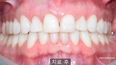 앞니 레진이 오래되어서 변색된 레진 교체 케이스 서울 시청 치과 관련 이미지 4