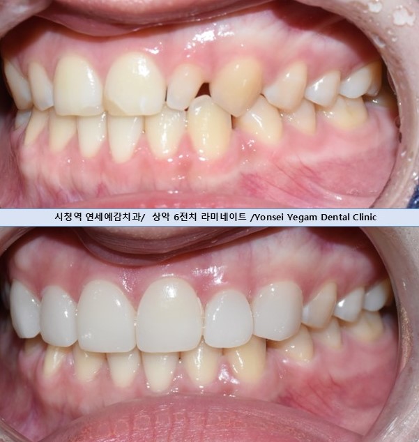 무삭제 라미네이트 치료로 자연스럽게! 왜소치+오래된 앞니레진까지 개선한 케이스 관련 이미지 1