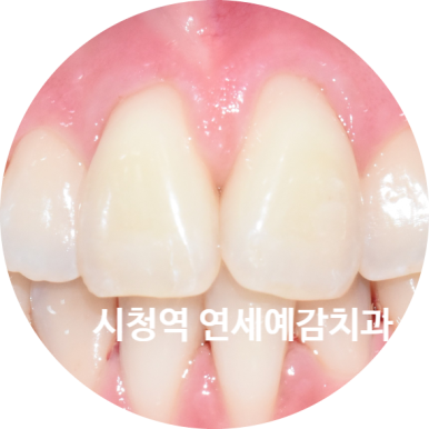 서울시청역 앞니 치아에 갈색 점, 흰색점 치료 전후 관련 이미지 9