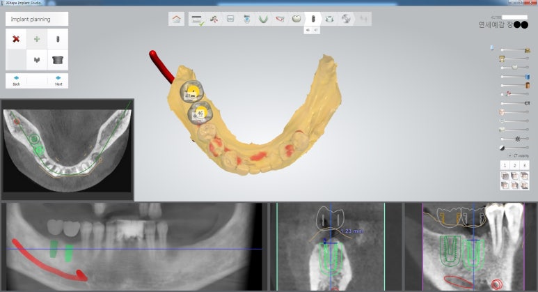 [북창동 치과/연세예감치과]내비게이션임플란트소개 관련 이미지 14