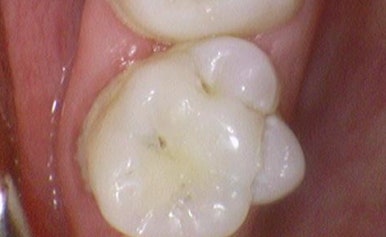 시청역 충정로 충치치료 치과 추천 관련 이미지 5