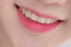 치과의사는 가족에게는 라미네이트 안한다고요? 저희 치과의사선생님은 본인 이에 직접 "프리네이트"하셨어요! 관련 이미지 8