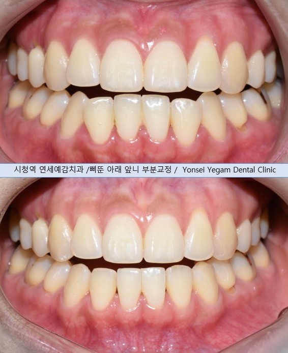 교정을 했었는데 앞니가 삐뚤어졌어요 &rarr;앞니 부분교정(재교정)사례. 2022 이벤트비용안내 관련 이미지 5