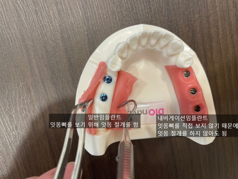 남대문시장 근처 치과 임플란트 연세.예감.치과 관련 이미지 3