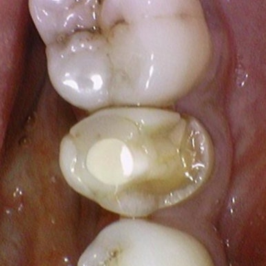 광화문 연세 예감 치과 해외에서도 찾아오는 지르코니아크라운 치료 안내해드려요 관련 이미지 15