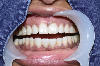 넘어져서 또는 부딪혀서 앞니 아주 많이 부러진 경우, 시청역치과 실제 앞니브릿지케이스 관련 이미지 16