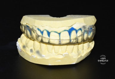 Teeth grinding, Bruxism: Botox, Night Guard in Seoul /  price 관련 이미지 1