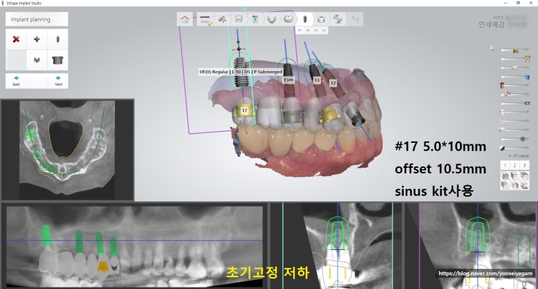 [시청역/서울역]네비게이션인플란트를 이용한 여러개 임플란트 과정 관련 이미지 5
