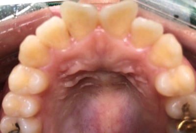 시청역치과 연세예감치과의 2번만의 내원으로 완성되는 고른앞니 만들기 케이스 소개 관련 이미지 5
