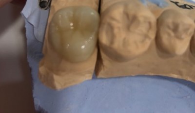 시청역치과/ 연세예감치과에서 "지르코니아 크라운" 알려드려요 관련 이미지 3