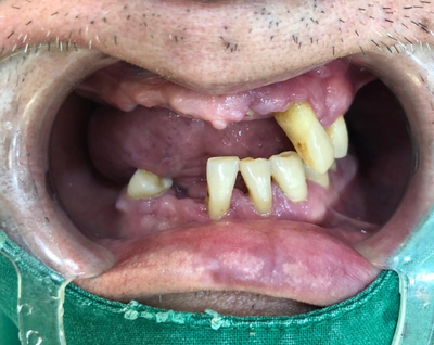 [남대문시장] 임플란트 조금 더 안아프고 간편하게 관련 이미지 1