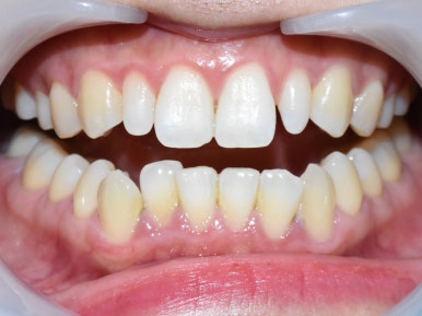 [서울/시청역] 왜소치 라미네이트 케이스 사례/비용/알려드려요 관련 이미지 4