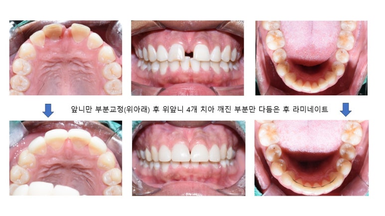 서울시청역치과/ 벌어진 앞니 치아 치료/ 왜소치, 다이아스테마 등/레진, 라미네이트, 부분교정 비교 관련 이미지 26