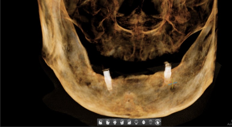 사용중인 틀니가 불편하다면? 임플란트와 틀니가 결합된 임플란트 틀니 추천 관련 이미지 20