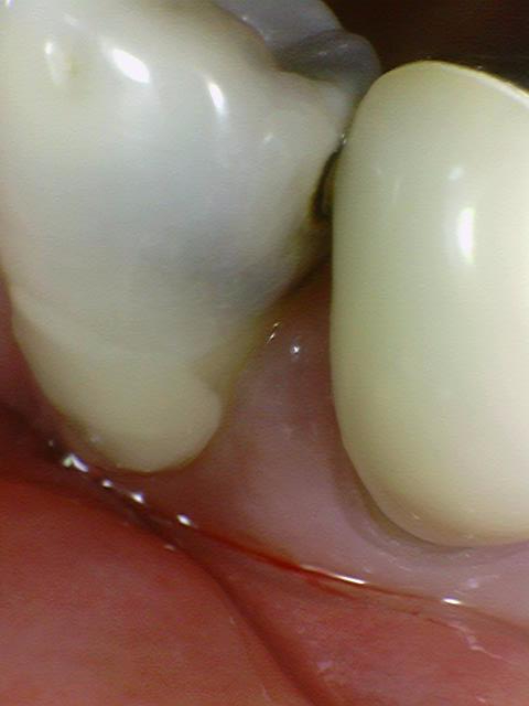 [충정로/치과]신경치료 할 만큼의 충치 제거 과정 공개 관련 이미지 1