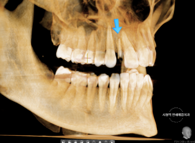 네비게이션임플란트 이용한 앞니 치료 유명한 치과 잔존 유치 케이스 관련 이미지 4