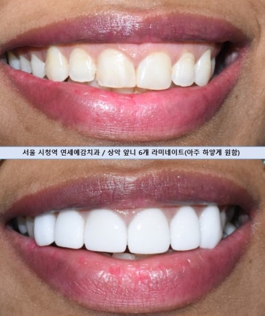 [서울/치과] 아주 하얀 앞니를 원한 외국인모델 환자분의 최소삭제 및 무삭제 라미네이트 사진과 가격공개 관련 이미지 2