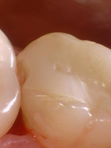 시청역치과 [Q&A]다른치과에서 한 인레이,크라운,임플란트에 음식물이 껴요 관련 이미지 5