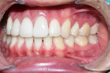 [광화문/치과] 외국인환자 변색된 앞니 하나의 크라운 치료 실제 케이스 관련 이미지 8