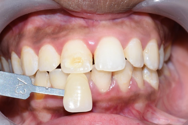 [서울역/충정로/치과] 화이트스팟+충치가 결합된 치아의 resin레진치료 케이스 관련 이미지 2