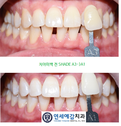 여름휴가 때 뭐하지 휴가 때 갈만한 곳? 관리하는 분들은 다 하는 치아미백 어떠세요? 관련 이미지 1
