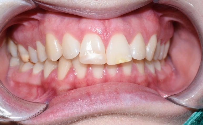 [서울역/을지로/치과] 본인이 옥니라고 생각한다면? 무삭제 라미네이트 어떤가요? 케이스 및 가격비용 관련 이미지 1