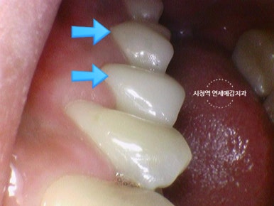 신경치료 끝났는데 크라운 해야하나요? 자연스러운 지르코니아 크라운 유명한 치과 가격까지 관련 이미지 6