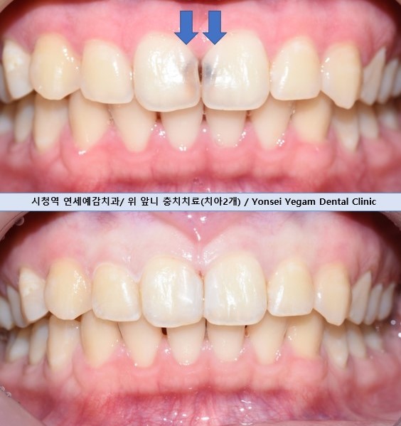 앞니충치가 너무 심해요 앞니 충치치료 방법 [시청역서울역 치과] 관련 이미지 2