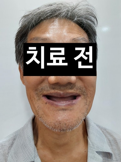 서울 중구 치과/이가 하나도 없는 환자의 치료방법/틀니, 풀아치임플란트, 전체 임플란트 등 관련 이미지 2