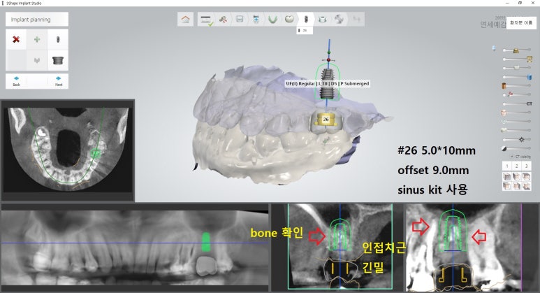[북창동 치과/연세예감치과]내비게이션임플란트소개 관련 이미지 24