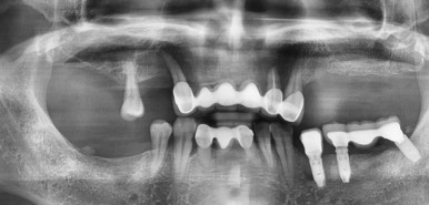 앞니 여러개 임플란트 잘하는 치과 서울역치과 실제사진 관련 이미지 17
