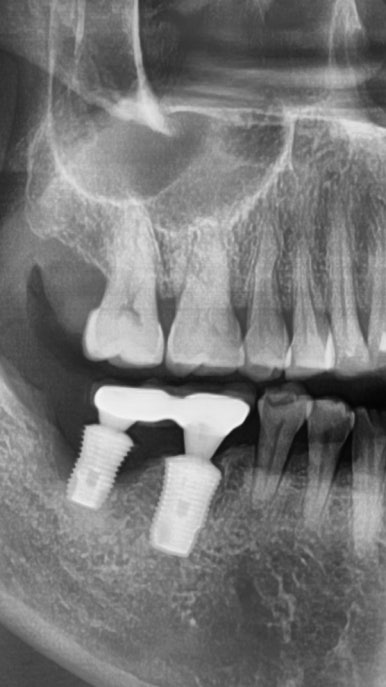 오래된 임플란트가 흔들려요 인플란트 재수술도 서울역가까운치과 연세예감치과 관련 이미지 12