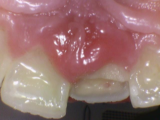 [광화문/연세예감치과] 앞니 치아가 파절되었다면? 앞니 부러짐.레진/크라운/임플란트 관련 이미지 12