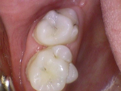 시청역치과추천 겁이 많은 치과공포증 어른들도 찾아오는 치과 여자원장님 진료 관련 이미지 15