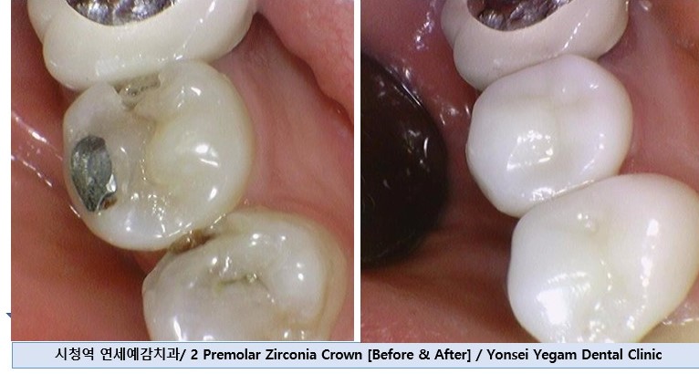 금크라운을 치아색 지르코니아 교체? 또는 크라운이 빠져서 새크라운?  광화문 시청역 서울역 치과, 가격까지! 관련 이미지 1