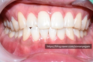 커피많이드세요? 치과에서 하는 치아미백 알려드려요[효과, 유지 등등 실제사례] 관련 이미지 6