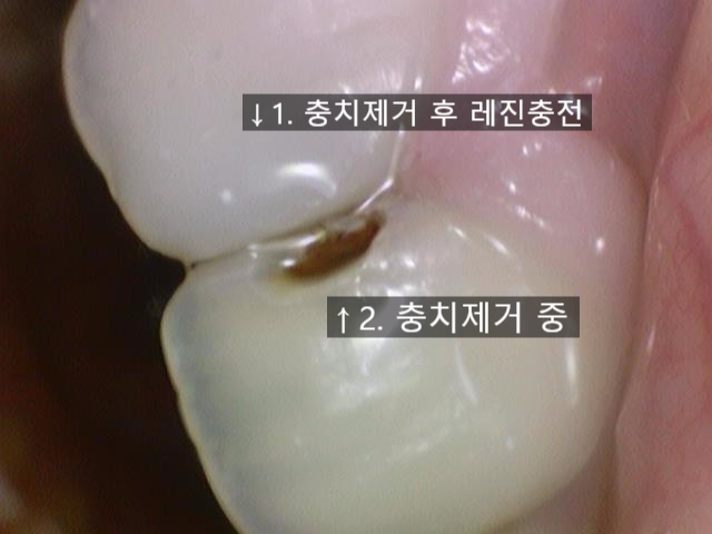 앞니충치가 너무 심해요 앞니 충치치료 방법 [시청역서울역 치과] 관련 이미지 8
