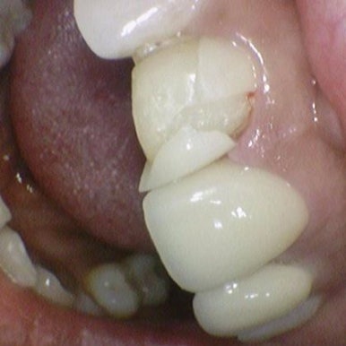 앞니 하나가 부러졌어요 앞니 크라운 앞니 브릿지 관련 이미지 5