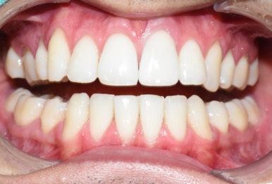 [광화문/치과] 외국인환자 변색된 앞니 하나의 크라운 치료 실제 케이스 관련 이미지 6