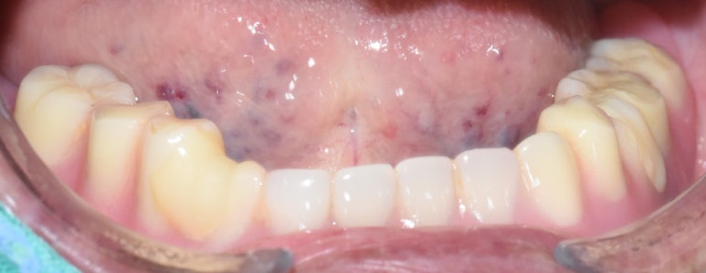 사용중인 틀니가 불편하다면? 임플란트와 틀니가 결합된 임플란트 틀니 추천 관련 이미지 23