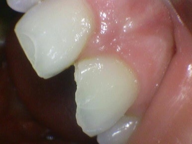 앞니깨짐 실제 치료 사례, 넘어져서 변색된 앞니 깨진 앞니 관련 이미지 2