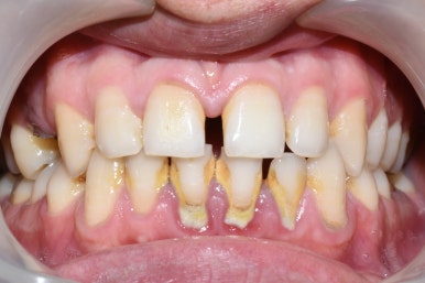 스케일링 처음 받는 분들도 많이 찾아오는 광화문 시청역 삼성본관 바로 앞 치과 관련 이미지 3