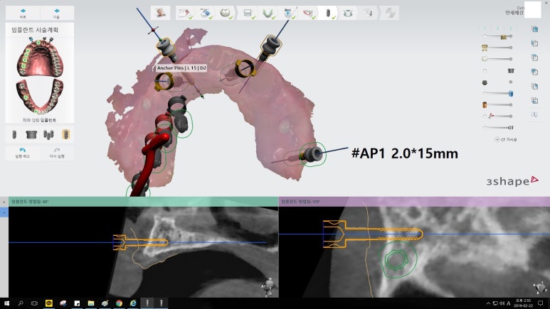 [남대문시장] 임플란트 조금 더 안아프고 간편하게 관련 이미지 5